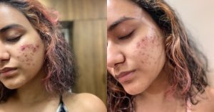 Malezia Acne Before After